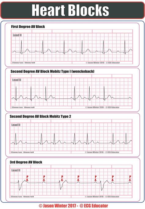 stripcheat|Printable Ekg Cheat Sheet